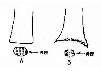 婴儿佝偻病