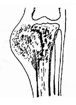 胫骨上端骨肉瘤（混合型）