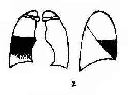 大叶性肺炎示意图
