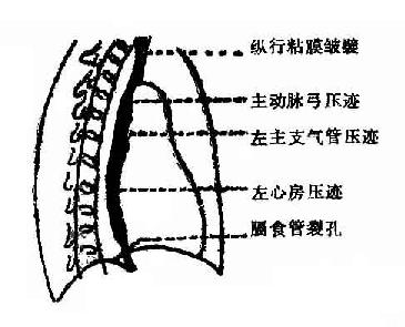 食管的生理性压迹