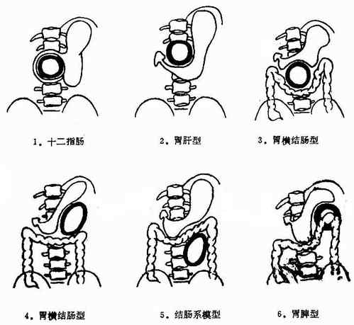 胰腺假性囊肿