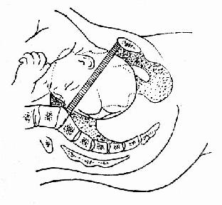胎头“衔接”示意图