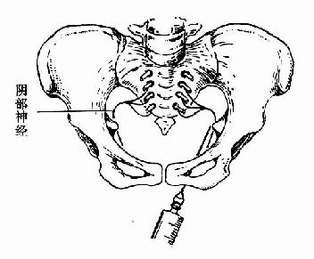 在坐骨棘内侧下方注入麻醉药
