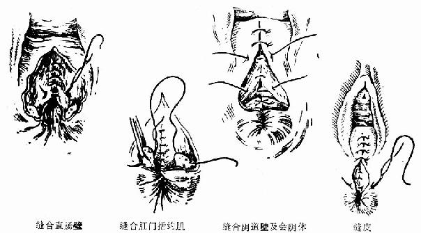 Ⅲ度会阴撕裂修复