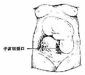 完全性子宫破裂