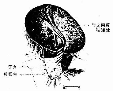 卵巢囊肺蒂扭转