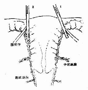 1.应斜向钳夹，以阴断全部上行血流2.垂直夹，可将部分血管遗漏