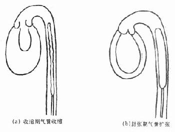 气囊反搏示意图