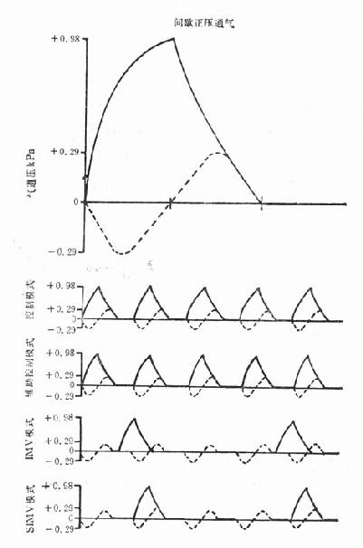 几种通气模式的典型气道压力曲线