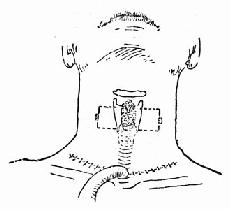 颈部低位横切口气管切开
