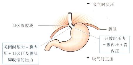 LES及其腹腔内位置