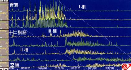 空腹期胃窦、十二指肠压力测定