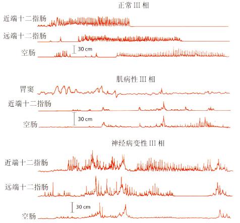 肌病性和神经病变性假性梗阻与正常人Ⅲ期活动的比较