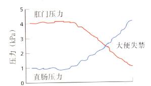 当直肠压力超过肛门压力时发生大便失禁