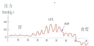 用定点牵拉法检查胃内压，LES压力及食管内压