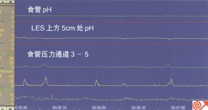 一例食管pH及动力联合检测