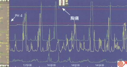 一例食管pH及动力联合检测