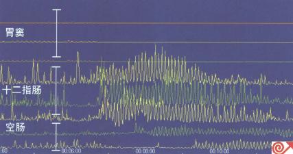 一例消化不良患者胃窦十二指肠测压表现