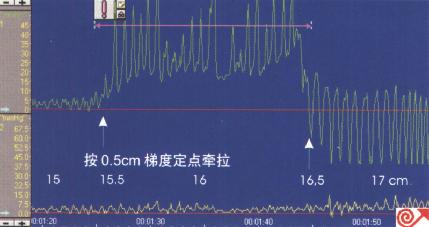 一例9月龄患儿食管定点牵拉测压图