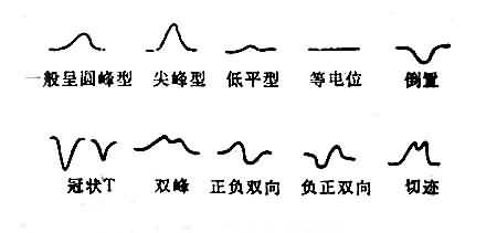 T波各种形态