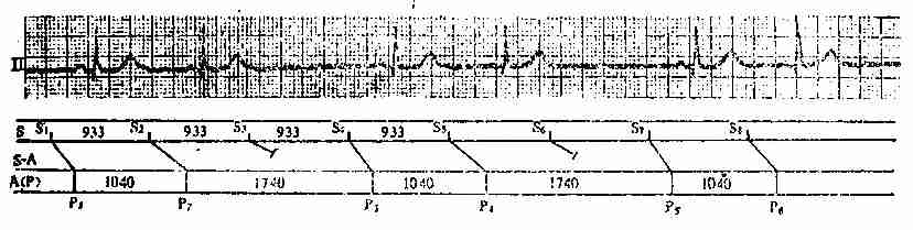 3:2的Ⅱ度窦房传导阻滞心电图