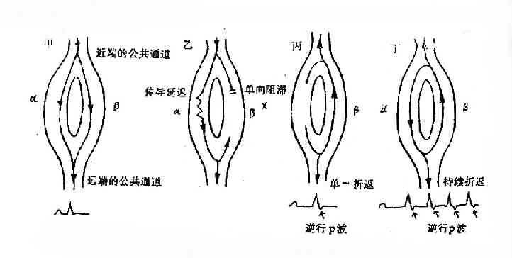 折返的机理示意图