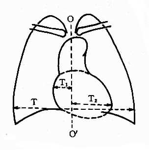 心胸比率测量图