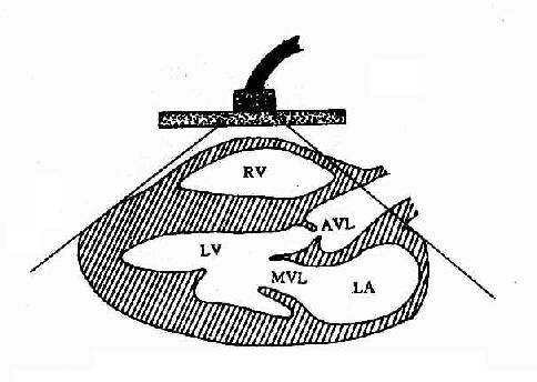 心超声胸骨旁长轴断面示意图