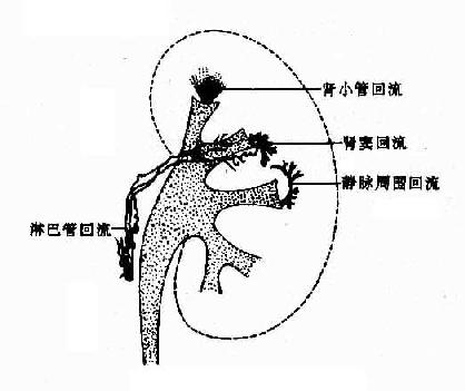 肾盂各种回流